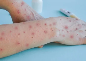 สสส. เตือน “ฝีดาษวานร” ระบาดระลอกใหม่ เผยยอดสะสมเกือบ 1,000 ราย พร้อมแนะวิธีป้องกัน