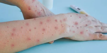 สสส. เตือน “ฝีดาษวานร” ระบาดระลอกใหม่ เผยยอดสะสมเกือบ 1,000 ราย พร้อมแนะวิธีป้องกัน