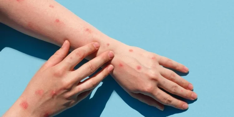 นนทบุรีขึ้นแท่นอันดับ 3 ยอดผู้ป่วย “ฝีดาษลิง” สะสม 50 ราย ติดง่ายกว่าที่คิด แค่สัมผัสใกล้ชิดก็เสี่ยง